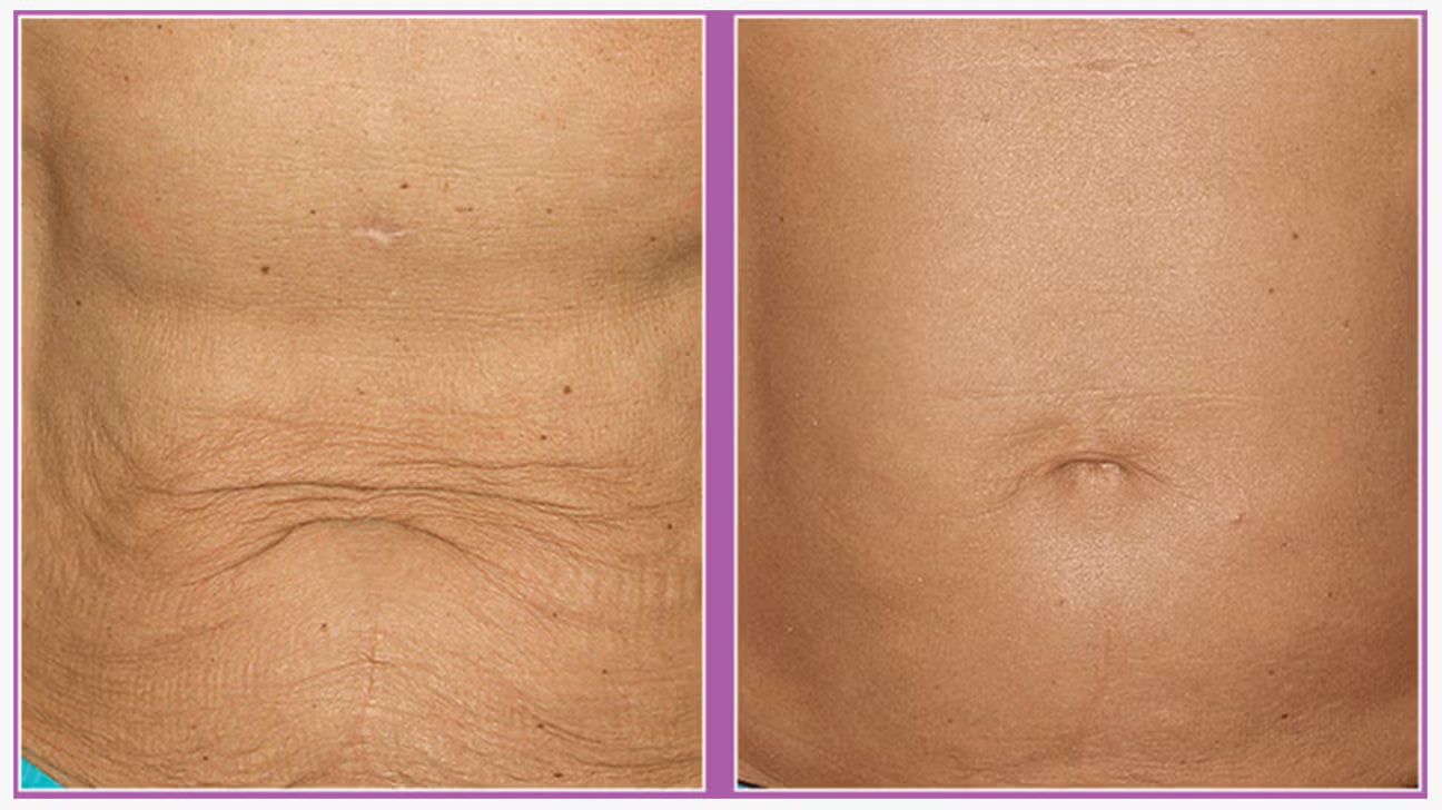3 session bundle with 3 body wraps
